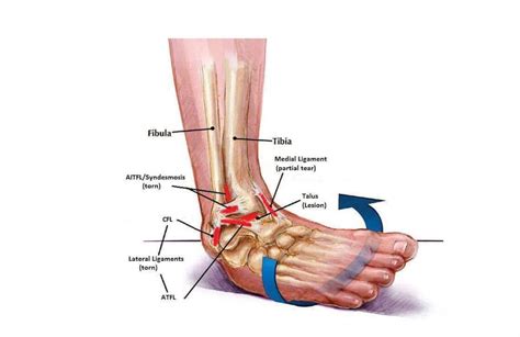 unguent pentru tratamentul ligamentelor articulației genunchiului artrita reumatoidă a simptomelor și tratamentului genunchiului